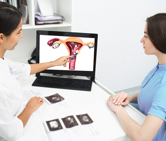 FIBROIDS